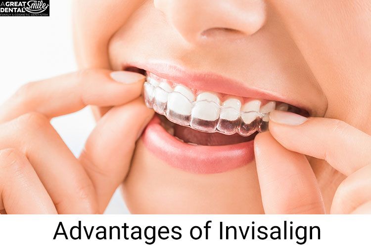 advantages-of-invisalign