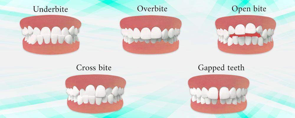 invisalign-candidate Las Vegas NV