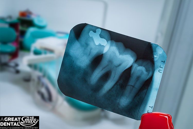 root-canal-x-ray las vegas