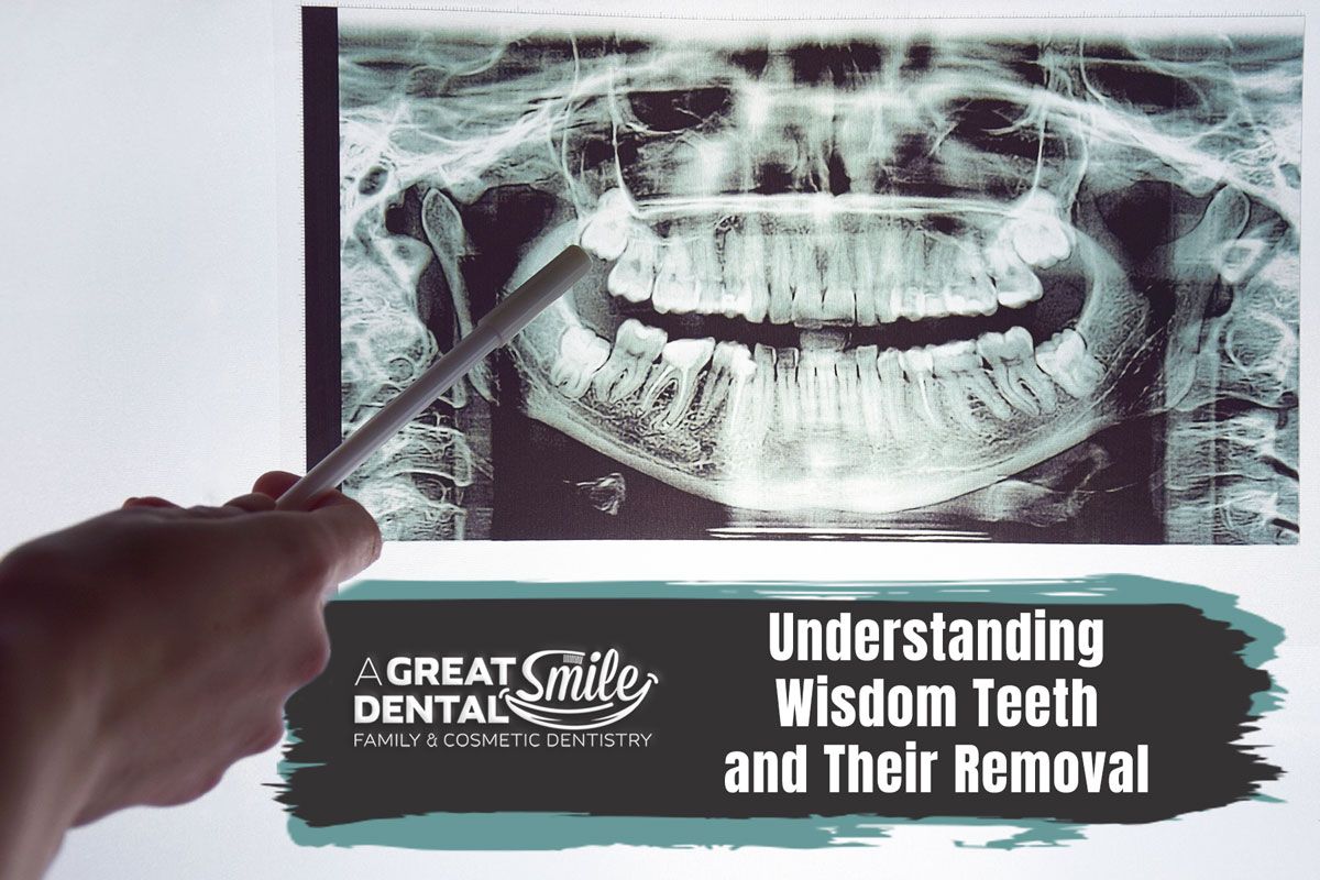 Understanding Wisdom Teeth and Their Removal