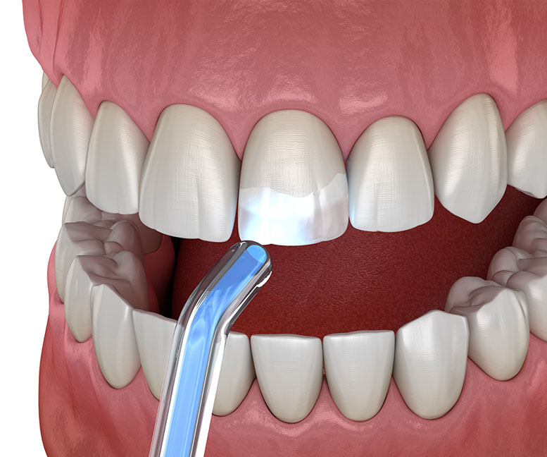 Dental Bonding Dentist in Las Vegas, NV 89129