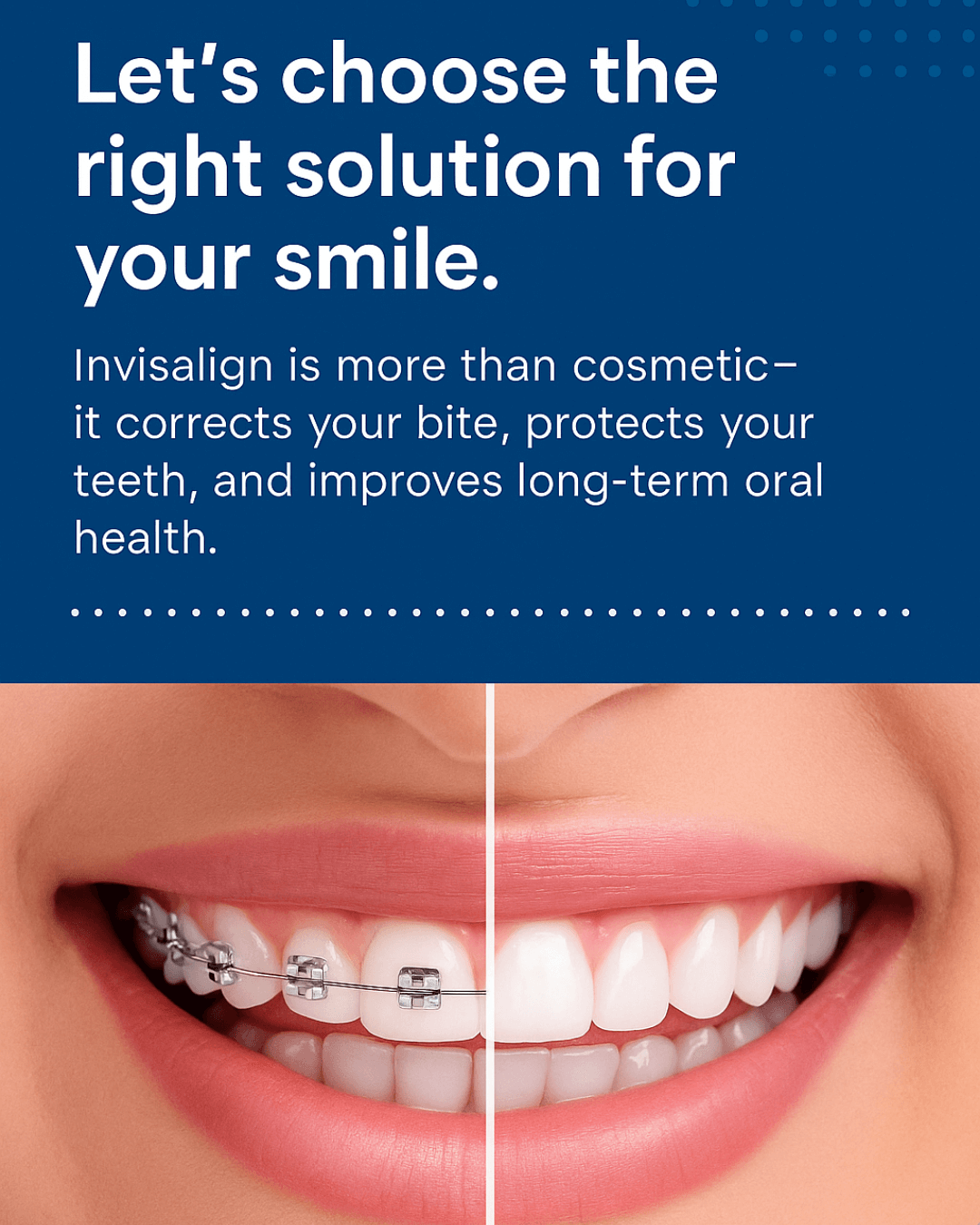 Invisalign Las Vegas before after 1 photo