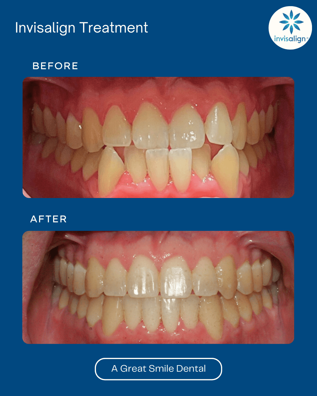 Invisalign Las Vegas before after 10