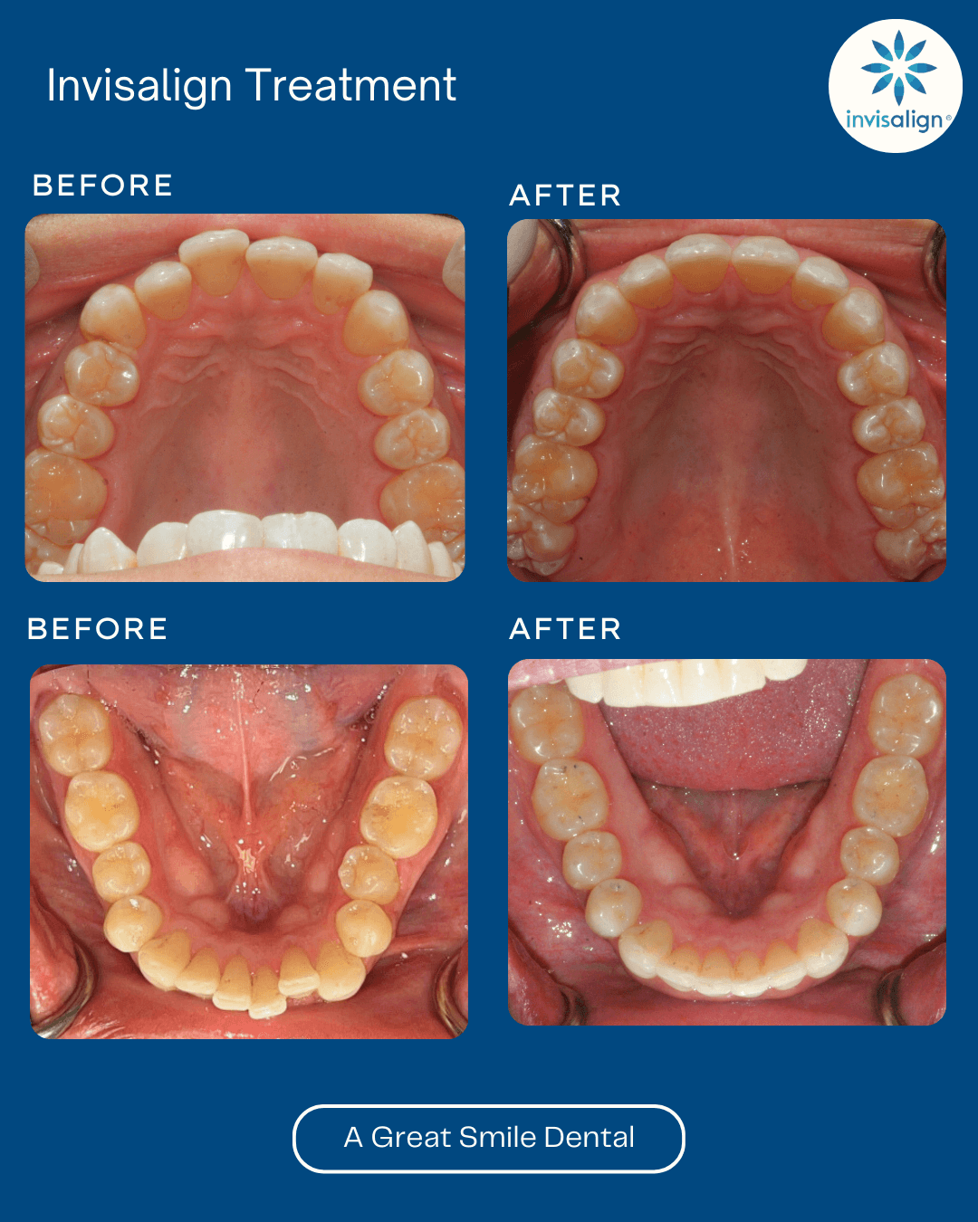 Invisalign Las Vegas before after 4