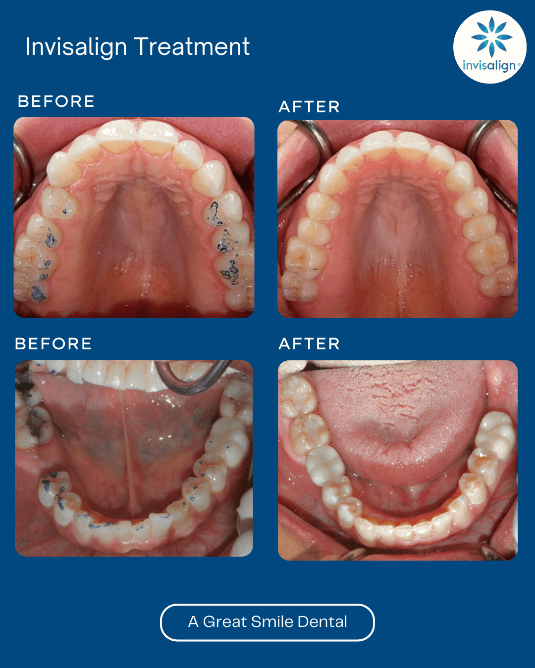 Invisalign Las Vegas before after 5