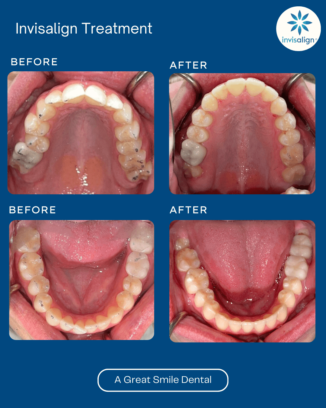 Invisalign Las Vegas before after 6