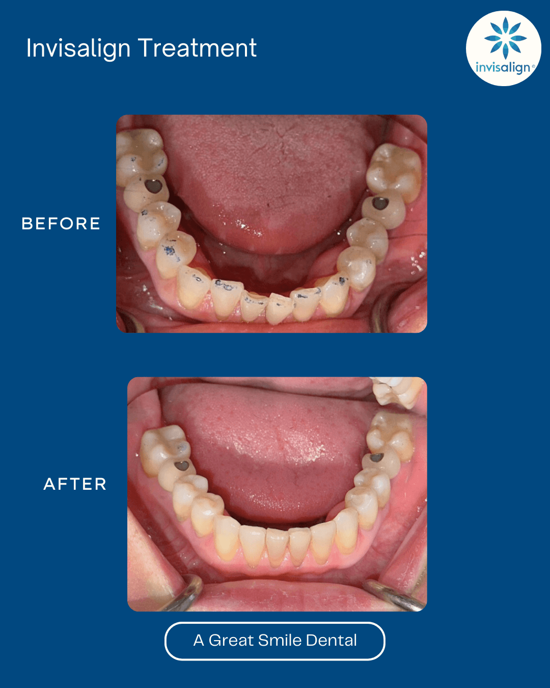Invisalign Las Vegas before after 7
