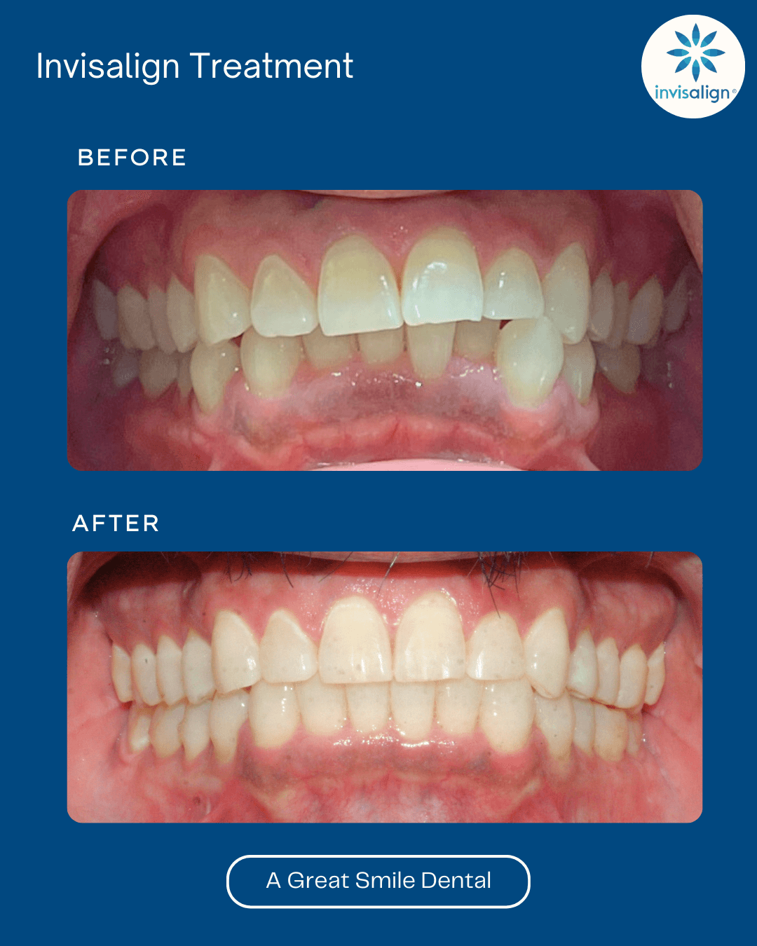 Invisalign Las Vegas before after 8