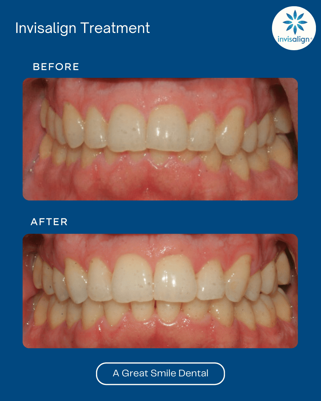 Invisalign Las Vegas before after 9