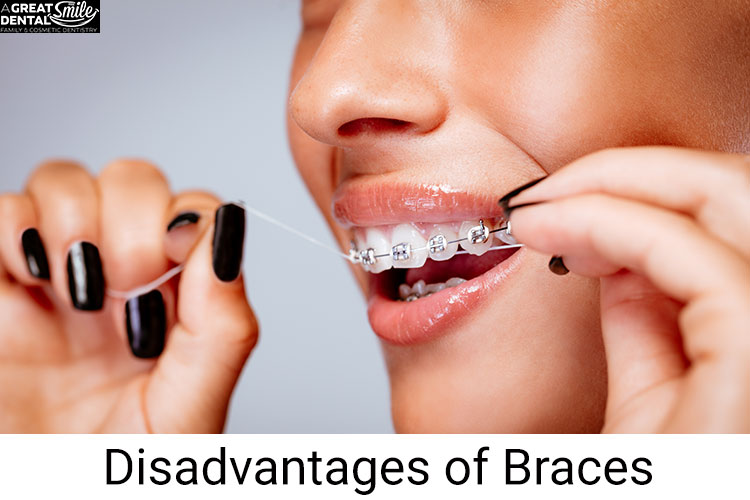Invisalign or Braces Weighing All Pros Cons