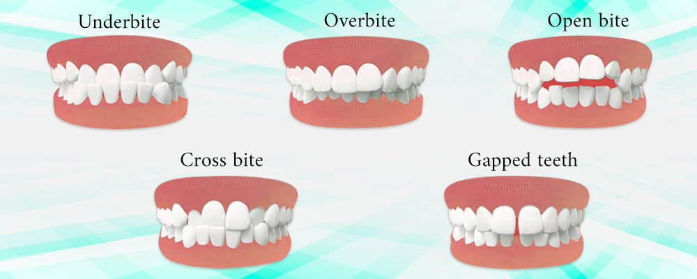 invisalign-candidate Las Vegas NV